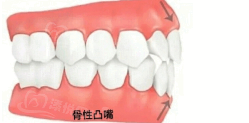 山东戴牙套矫正大概多少钱？一般在5000 - 50000元，不同牙套类型价格有别