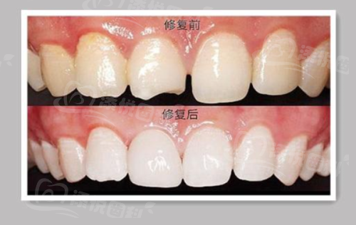 南京美奥口腔门诊部价格表揭秘！种植牙8099元起、矫正8888元起，项目实惠超心动！ 
