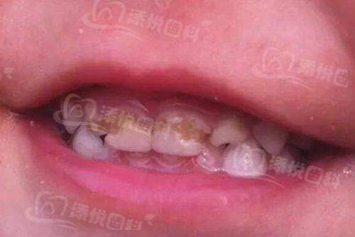 盐城双宝口腔医院收费贵吗？不贵！种植牙低至2600元/颗，多样项目价格实惠超划算！ 