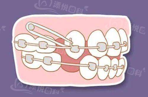 西安浅龋手术价格一览表揭秘！基础树脂补牙200 - 500元，西北大学一院口腔科口碑超棒！ 