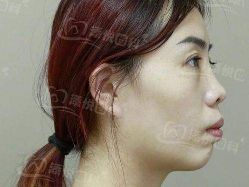 青岛维乐口腔医院凸嘴矫正费用多少？价格合理透明，能让你轻松实现颜值蜕变，真的香！ 