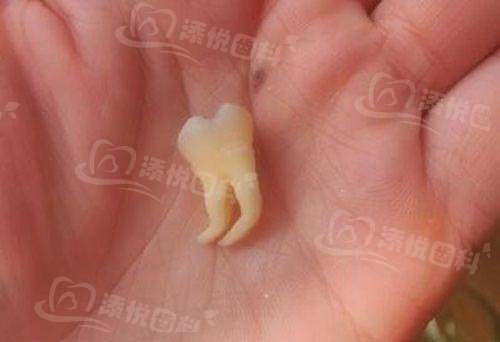 包头幸福口腔医院收费标准：单颗种植牙2680元，全口假牙8000元起！ 