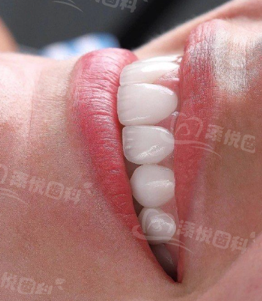 泰州博恩口腔门诊部种植牙多少钱？3980元起，多种品牌可选，满足不同需求！ 