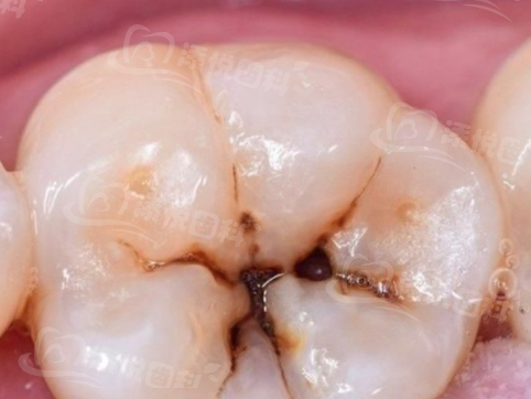 潍坊可恩口腔医院牙齿矫正多少钱？金属托槽6800起，多种矫正方式可选，满足不同需求！ 