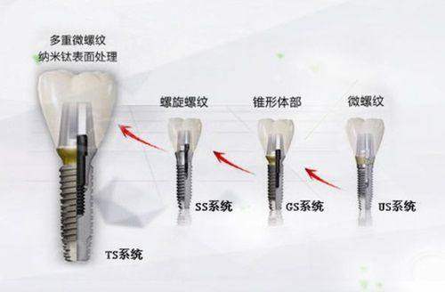 三、厦门麦芽口腔种牙实例及口碑如何？www.tyck.cn