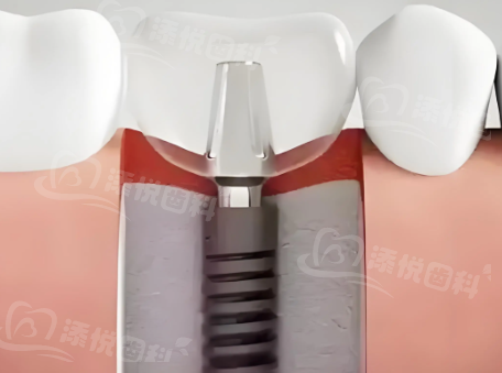 三、重庆正舸口腔贴面价格参考www.tyck.cn