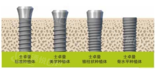 二、西宁诺贝尔数字化导板种植技术解析www.tyck.cn